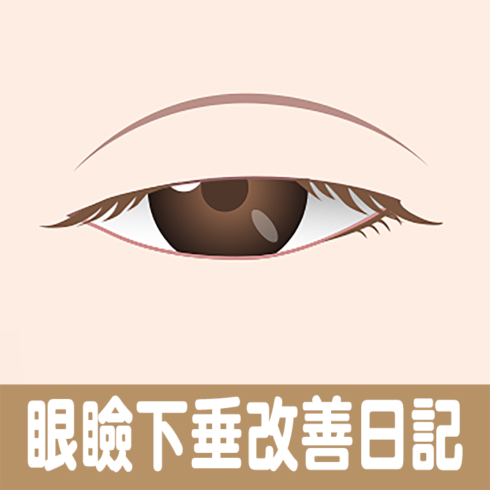 眼瞼下垂,治す,治療,横浜,川崎,さいたま,東京